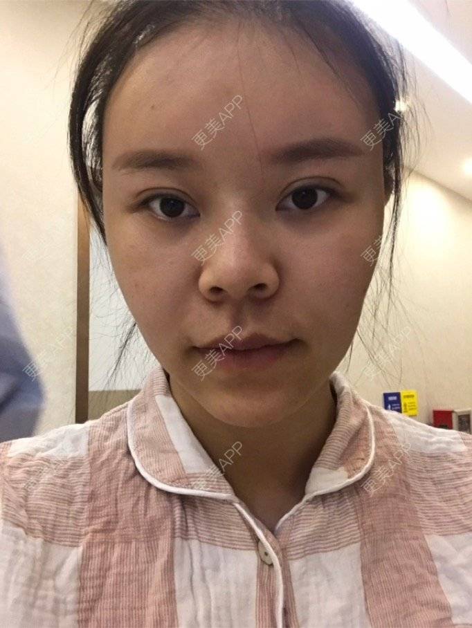更美 - 更美用户iuB00h31N3的鼻部多项经验 | 鼻部多项 | 广州