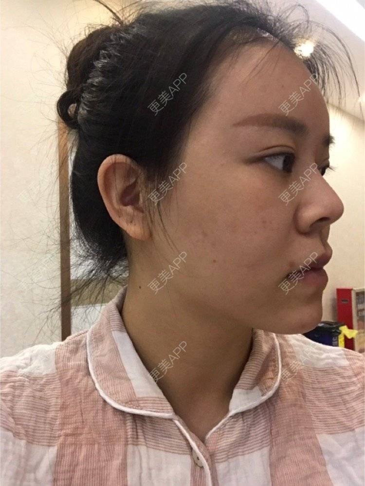 更美 - 更美用户iuB00h31N3的鼻部多项经验 | 鼻部多项 | 广州