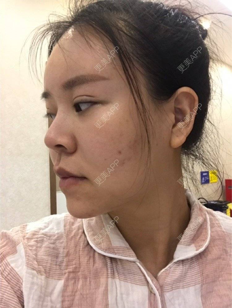 更美 - 更美用户iuB00h31N3的鼻部多项经验 | 鼻部多项 | 广州