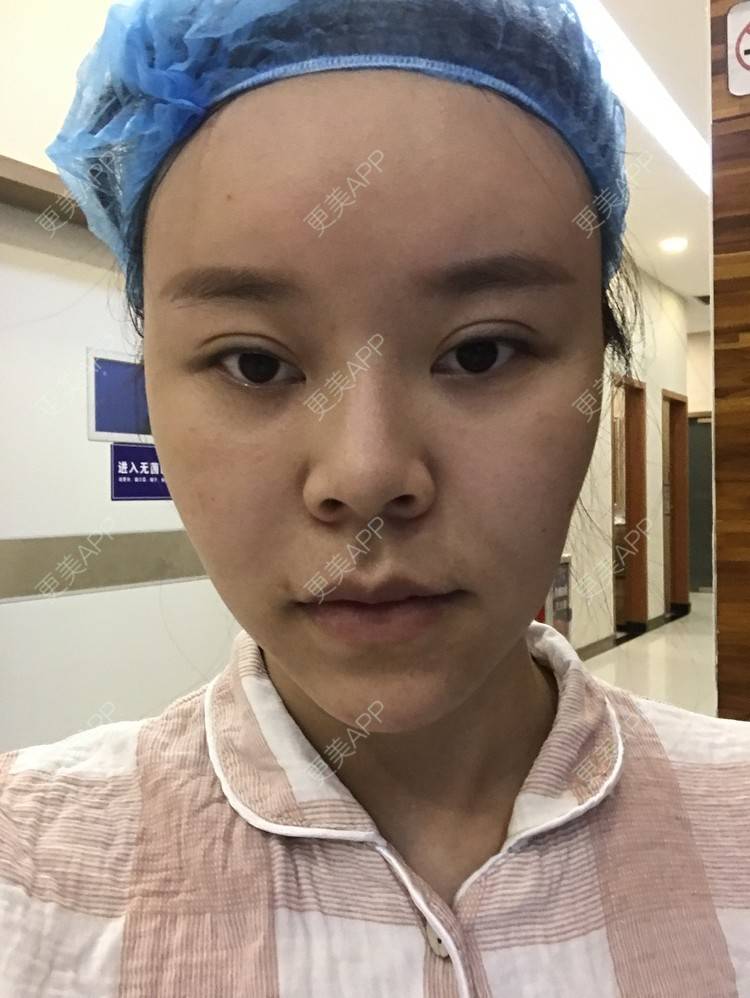 更美 - 更美用户iuB00h31N3的鼻部多项经验 | 肋软骨隆鼻 | 鼻部多项 | 广州
