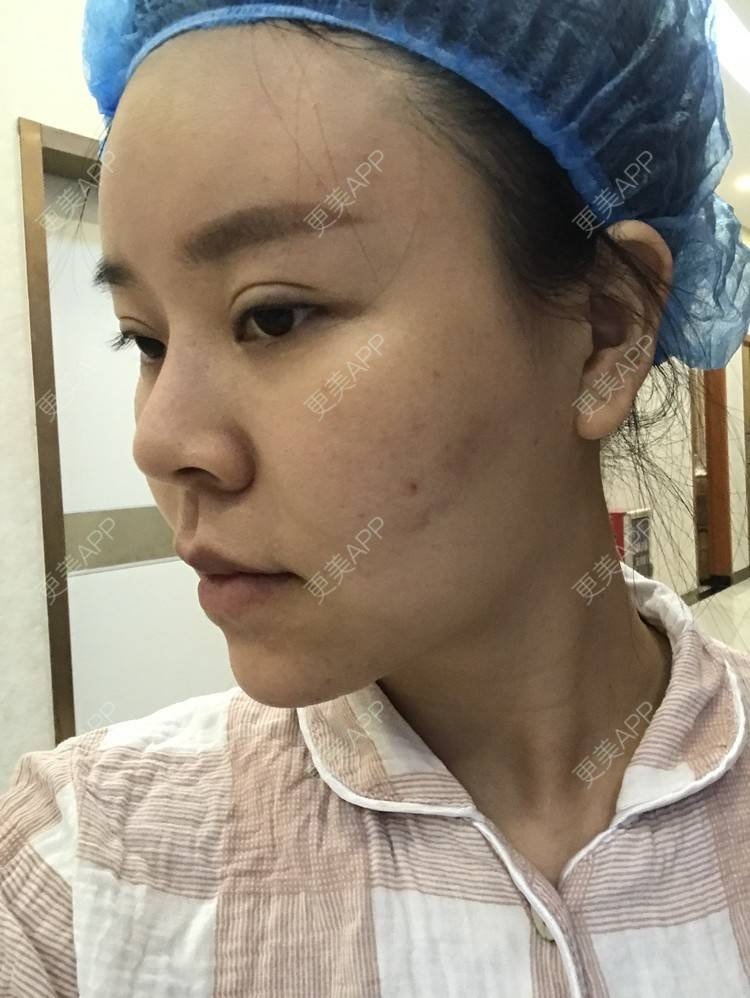 更美 - 更美用户iuB00h31N3的鼻部多项经验 | 肋软骨隆鼻 | 鼻部多项 | 广州