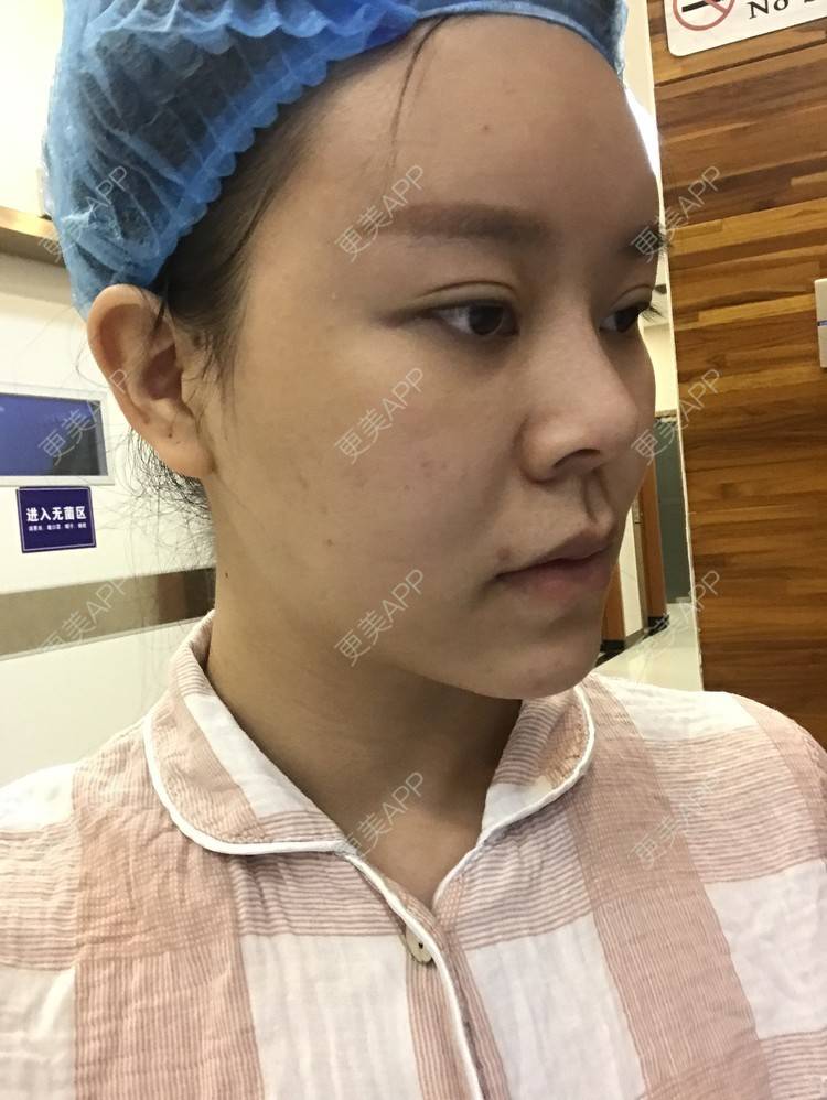更美 - 更美用户iuB00h31N3的鼻部多项经验 | 肋软骨隆鼻 | 鼻部多项 | 广州