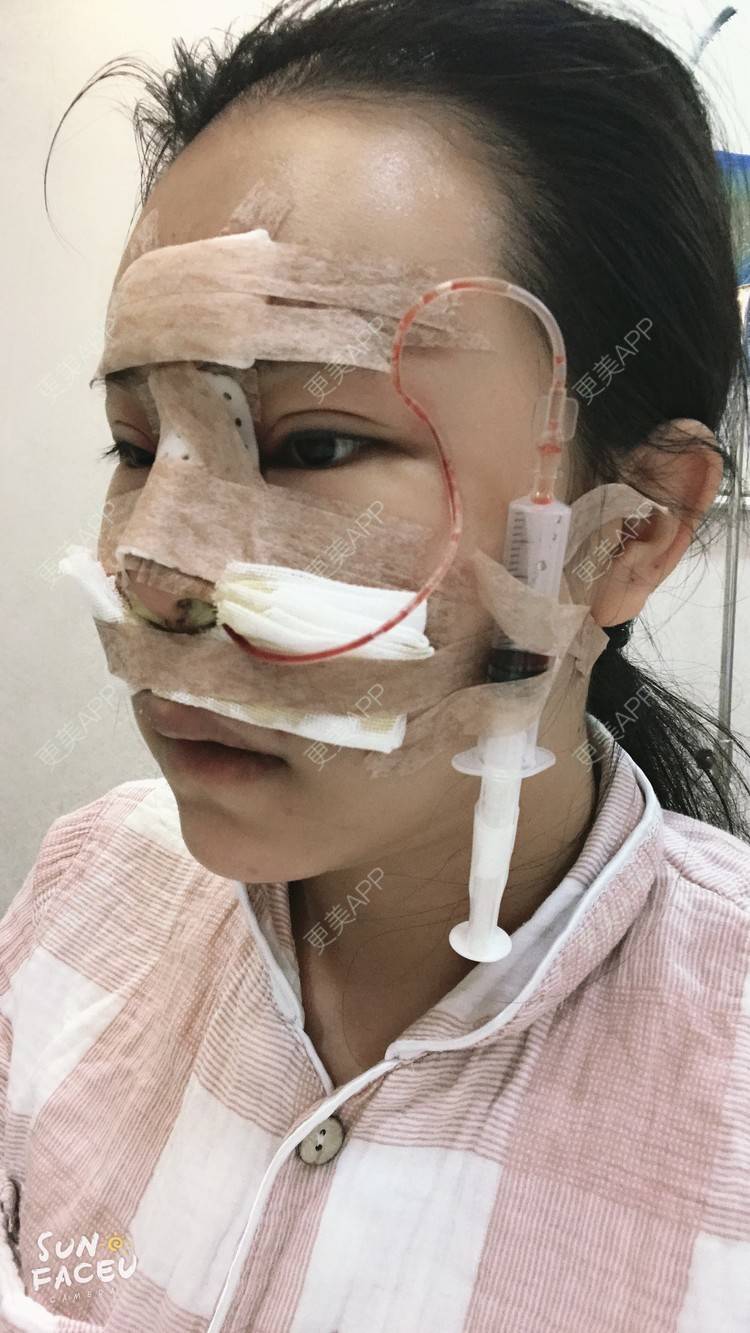更美 - 更美用户iuB00h31N3的鼻部多项经验 | 肋软骨隆鼻 | 鼻部多项 | 广州