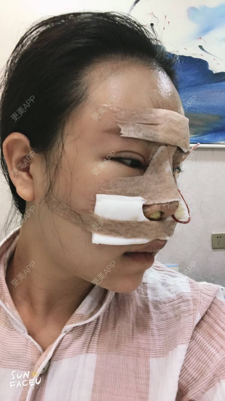 更美 - 更美用户iuB00h31N3的鼻部多项经验 | 肋软骨隆鼻 | 鼻部多项 | 广州
