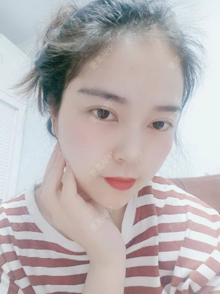 更美 - 更美用户uK1ce6rfue的全切双眼皮经验 | 广州 | 眼部综合