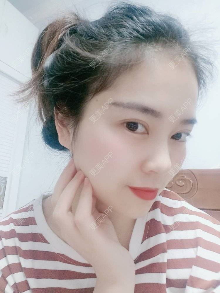 更美 - 更美用户uK1ce6rfue的全切双眼皮经验 | 广州 | 眼部综合