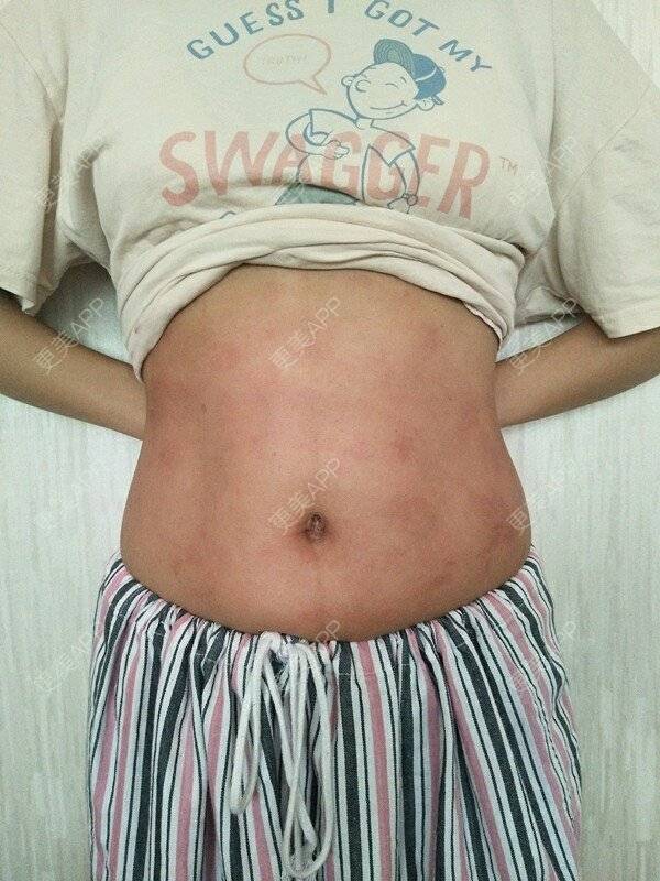 更美 - 更美用户a9m2heua4c的冷冻溶脂经验 | 冷冻溶脂