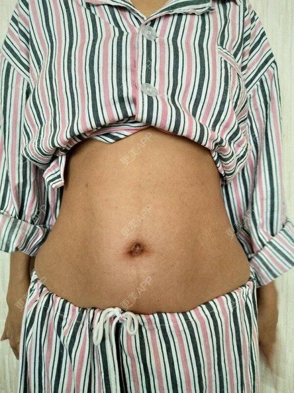 更美 - 更美用户a9m2heua4c的冷冻溶脂经验 | 冷冻溶脂