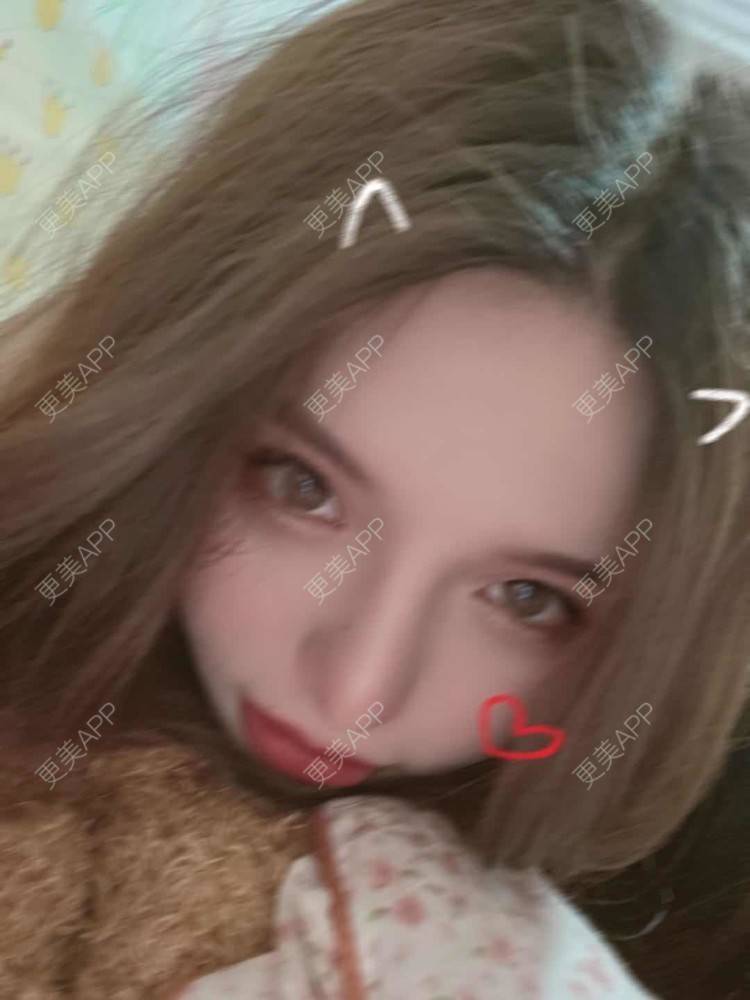 更美 - 依依若有情状的隆鼻经验 | 鼻部多项 | 手术缩鼻头 | 自体脂肪隆鼻 | 肋软骨隆鼻 | 人工骨隆鼻 | 真皮隆鼻 | 鼻小柱缩短 | 微晶瓷隆鼻 | 全脸整形套餐