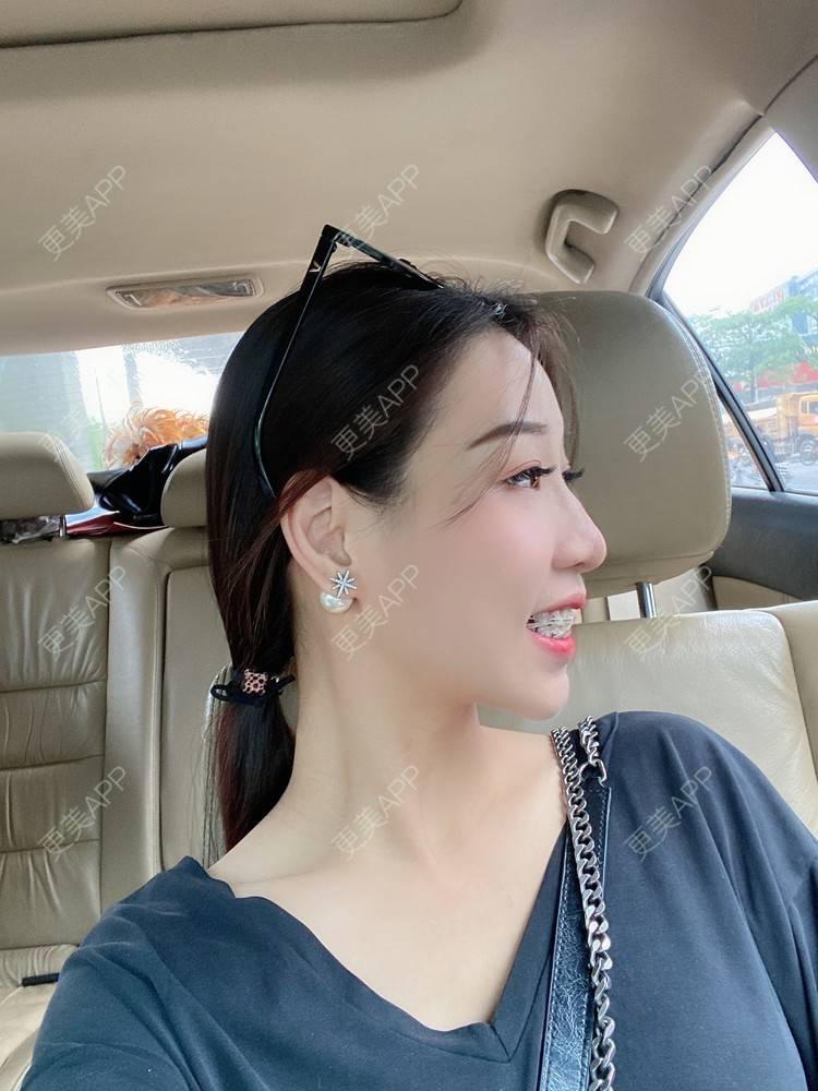 更美 - －Ｊane.’的牙齿矫正经验 | 牙齿矫正 | 广州