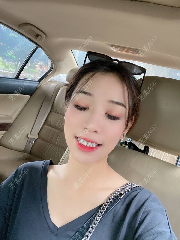 更美 - －Ｊane.’的牙齿矫正经验 | 牙齿矫正 | 广州