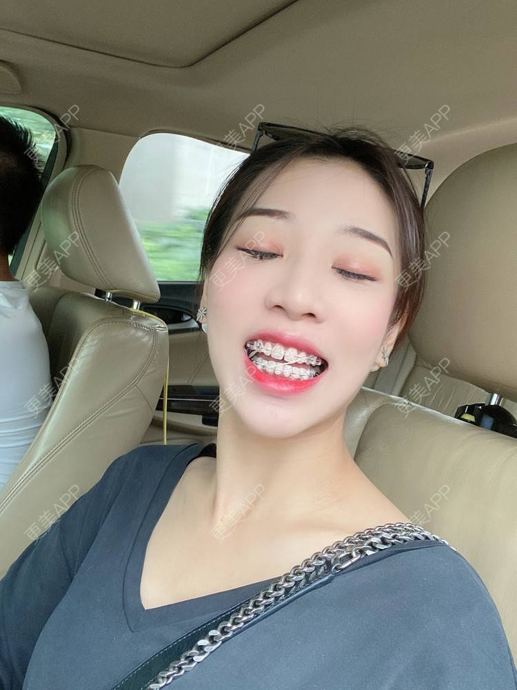 更美 - －Ｊane.’的牙齿矫正经验 | 牙齿矫正 | 广州