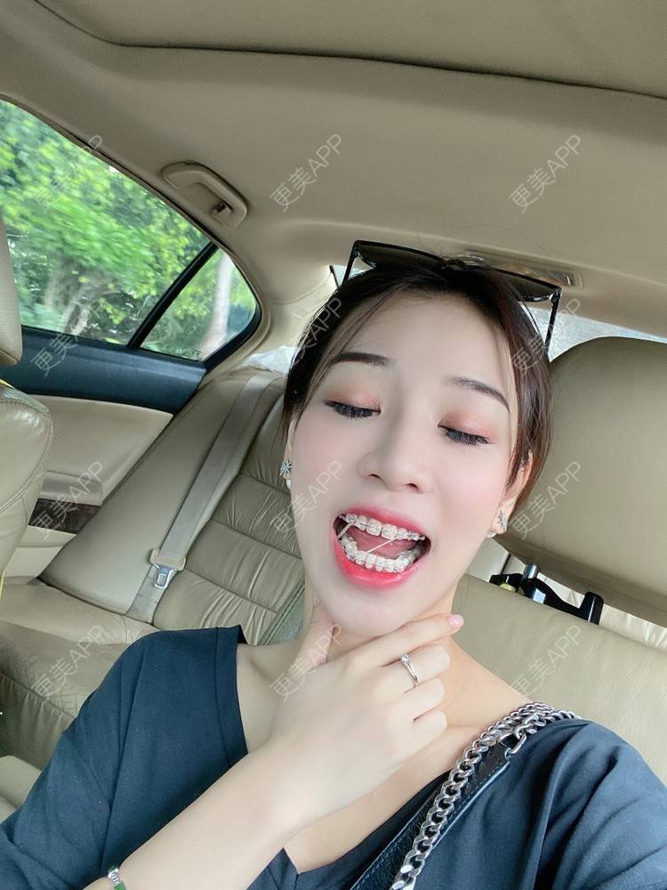更美 - －Ｊane.’的牙齿矫正经验 | 牙齿矫正 | 广州