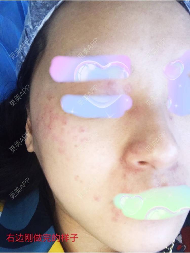 更美 - 老沙沙师弟、的激光淡斑经验 | 武汉 | 激光淡斑
