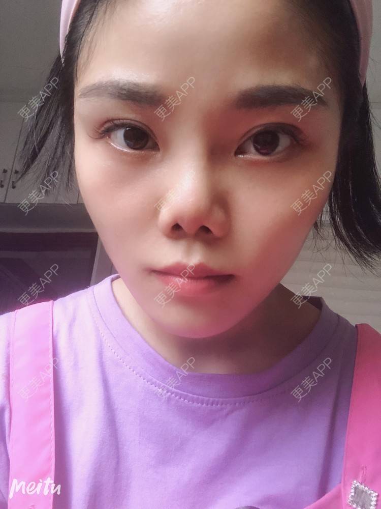 更美 - 艺韩的眶隔脂肪释放经验 | 重庆 | 眶隔脂肪释放