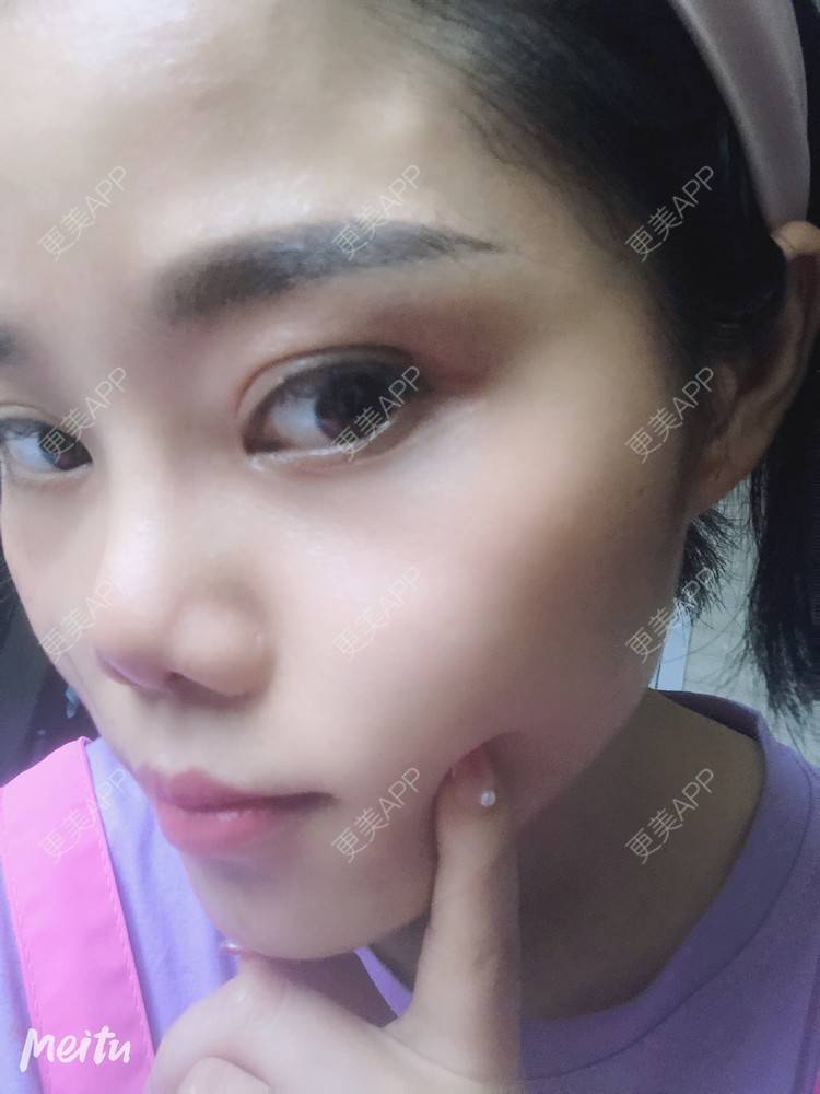更美 - 艺韩的眶隔脂肪释放经验 | 重庆 | 眶隔脂肪释放