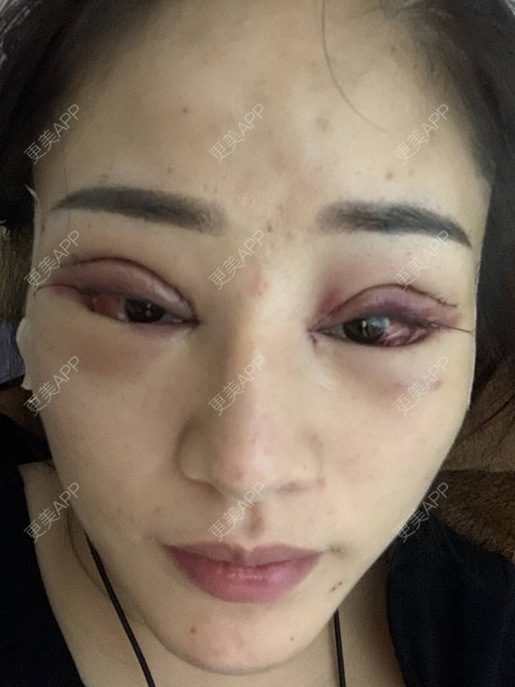 更美 - 我要变美丽漂亮的双眼皮经验 | 双眼皮 | 武汉
