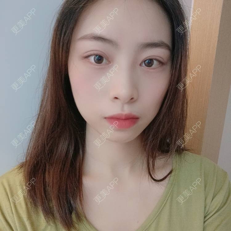 更美 - 蔓蔓青萝-的双眼皮经验 | 双眼皮 | 开内眼角 | 内切去眼袋 | 重庆
