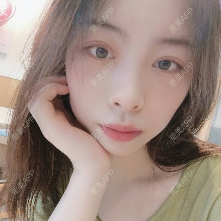 更美 - 蔓蔓青萝-的双眼皮经验 | 双眼皮 | 开内眼角 | 内切去眼袋 | 重庆