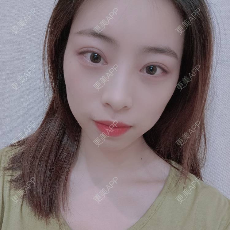 更美 - 蔓蔓青萝-的双眼皮经验 | 双眼皮 | 开内眼角 | 内切去眼袋 | 重庆