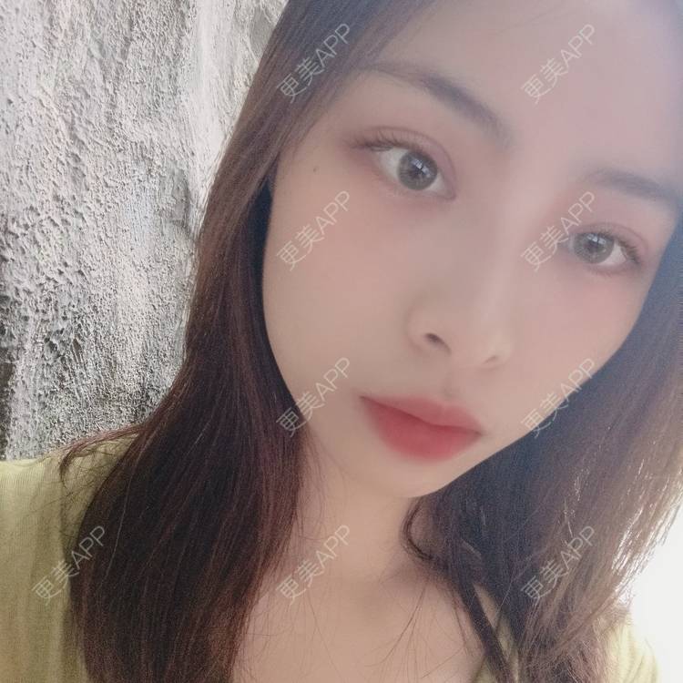 更美 - 蔓蔓青萝-的双眼皮经验 | 双眼皮 | 开内眼角 | 内切去眼袋 | 重庆