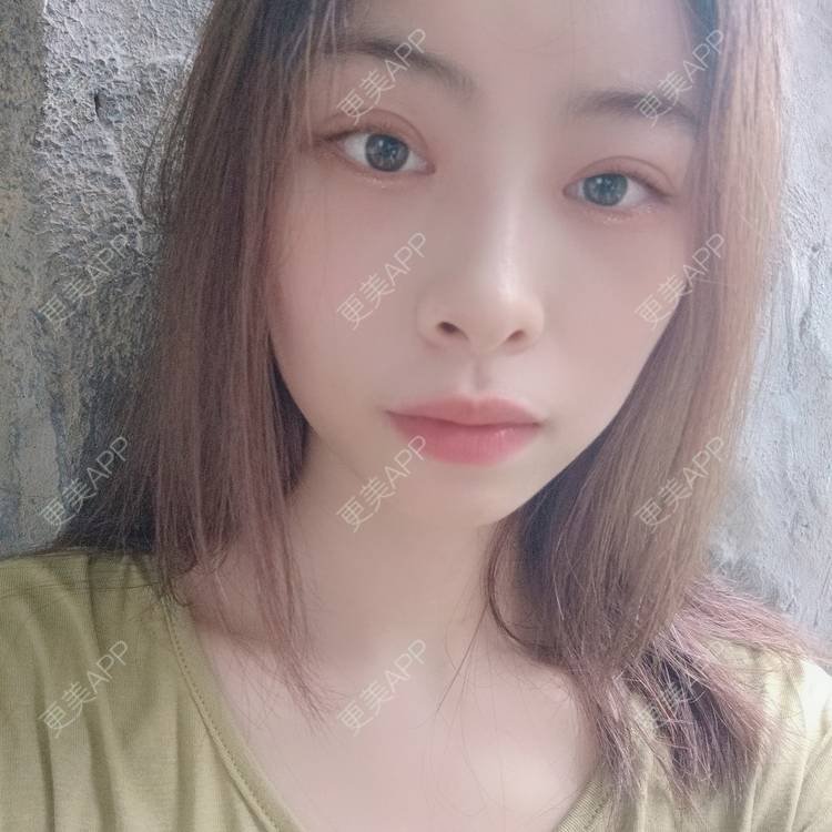 更美 - 蔓蔓青萝-的双眼皮经验 | 双眼皮 | 开内眼角 | 内切去眼袋 | 重庆