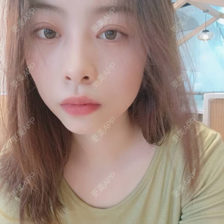 更美 - 蔓蔓青萝-的双眼皮经验 | 双眼皮 | 开内眼角 | 内切去眼袋 | 重庆