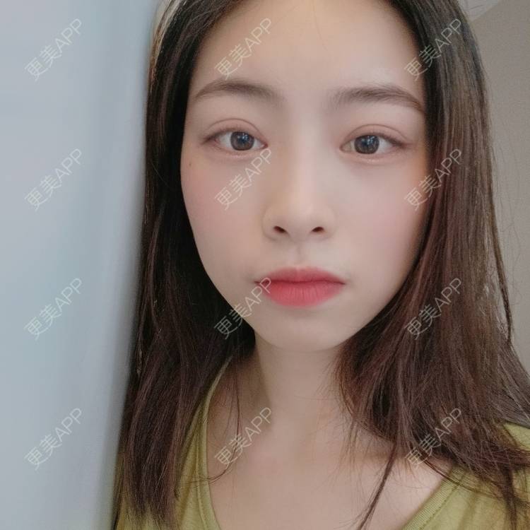 更美 - 蔓蔓青萝-的双眼皮经验 | 双眼皮 | 开内眼角 | 内切去眼袋 | 重庆