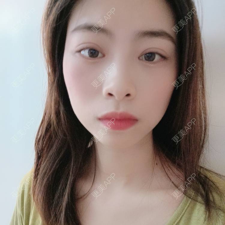 更美 - 蔓蔓青萝-的双眼皮经验 | 双眼皮 | 开内眼角 | 内切去眼袋 | 重庆