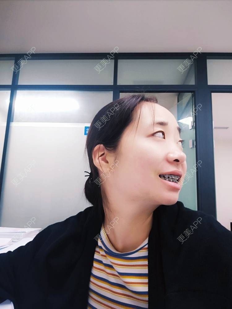 更美 - 橙子Jiang的牙齿矫正经验 | 牙齿矫正 | 成都