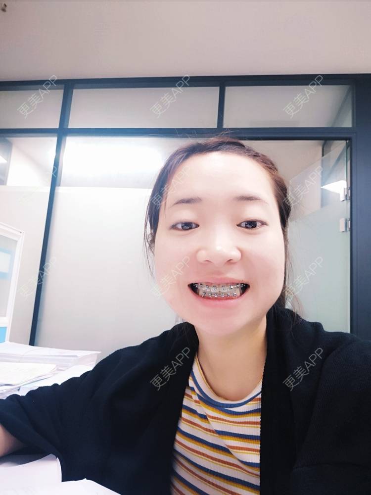 更美 - 橙子Jiang的牙齿矫正经验 | 牙齿矫正 | 成都