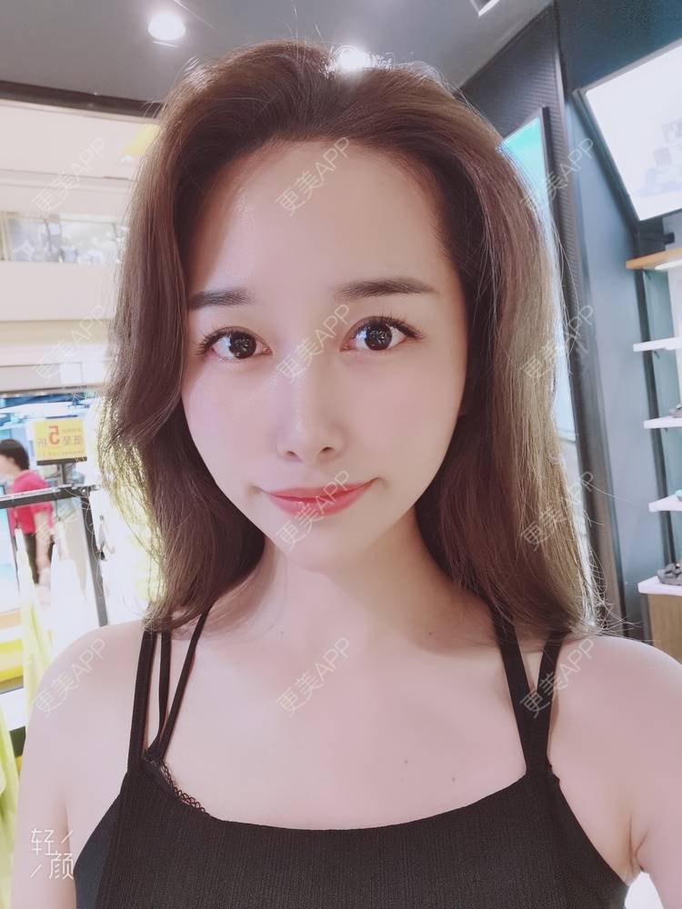 更美 - 甜心泡芙的双眼皮修复经验 | 双眼皮 | 全切双眼皮 | 开内眼角 | 重庆 | 双眼皮修复