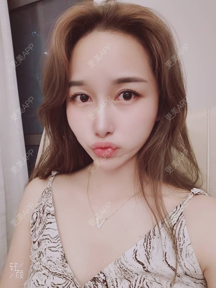 更美 - 甜心泡芙的双眼皮修复经验 | 双眼皮 | 全切双眼皮 | 开内眼角 | 重庆 | 双眼皮修复