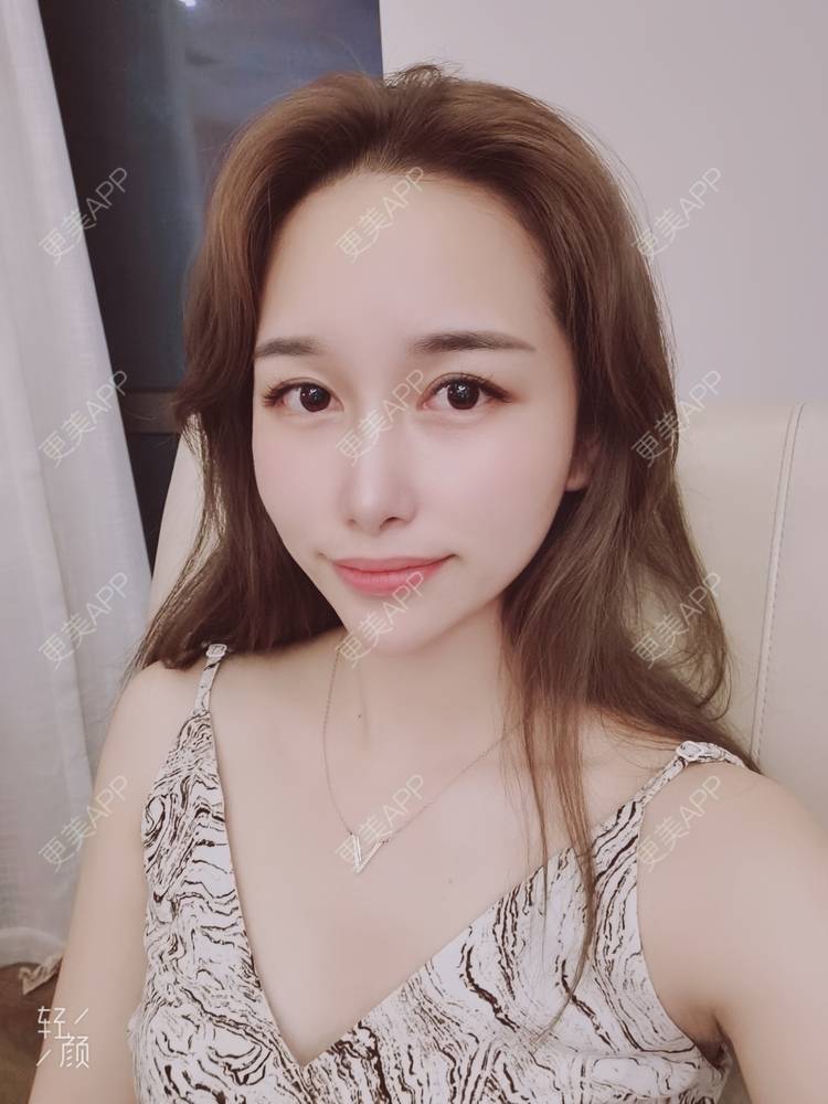 更美 - 甜心泡芙的双眼皮修复经验 | 双眼皮 | 全切双眼皮 | 开内眼角 | 重庆 | 双眼皮修复