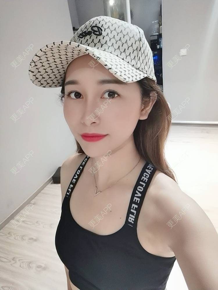 更美 - 甜心泡芙的双眼皮修复经验 | 双眼皮 | 全切双眼皮 | 开内眼角 | 重庆 | 双眼皮修复