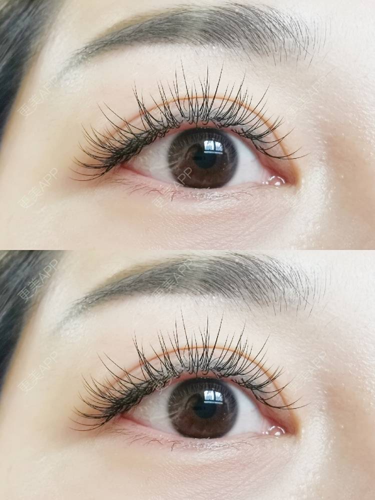 更美 - 甜心泡芙的双眼皮修复经验 | 双眼皮 | 全切双眼皮 | 开内眼角 | 重庆 | 双眼皮修复