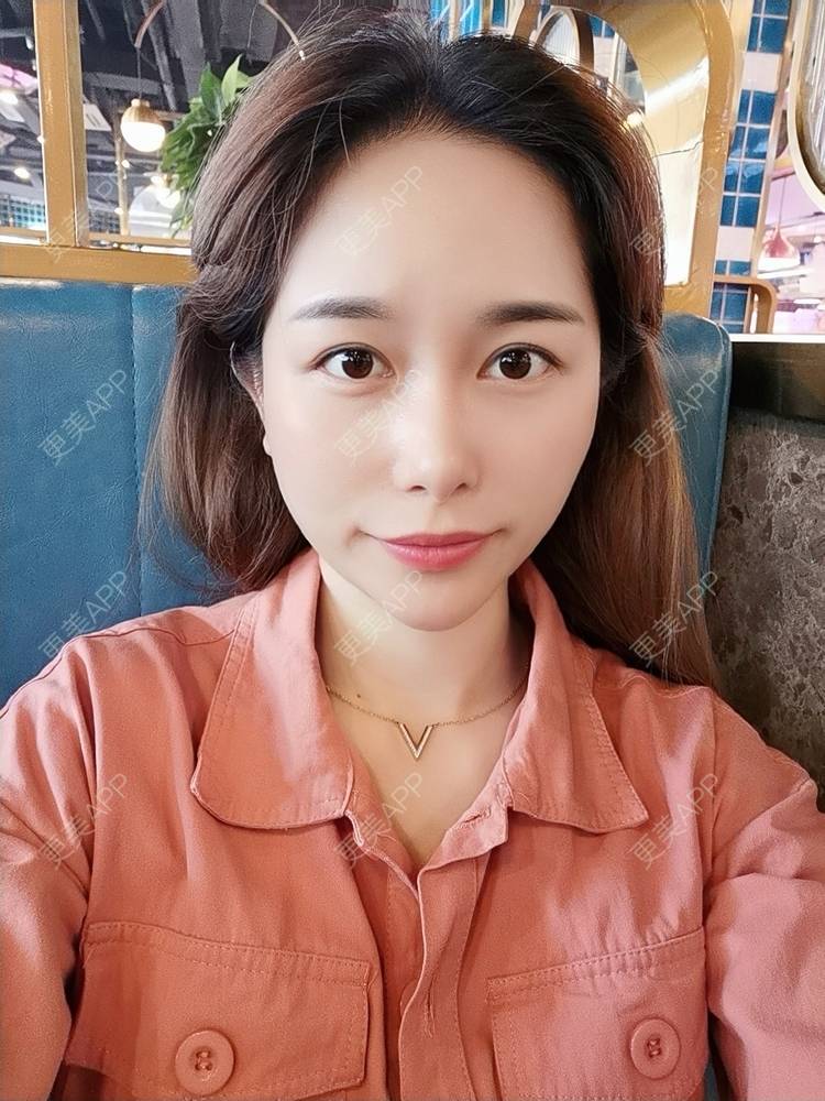 更美 - 甜心泡芙的双眼皮修复经验 | 双眼皮 | 全切双眼皮 | 开内眼角 | 重庆 | 双眼皮修复