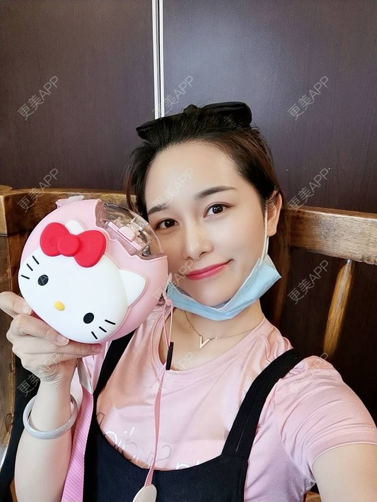 更美 - 甜心泡芙的双眼皮修复经验 | 双眼皮 | 全切双眼皮 | 开内眼角 | 重庆 | 双眼皮修复