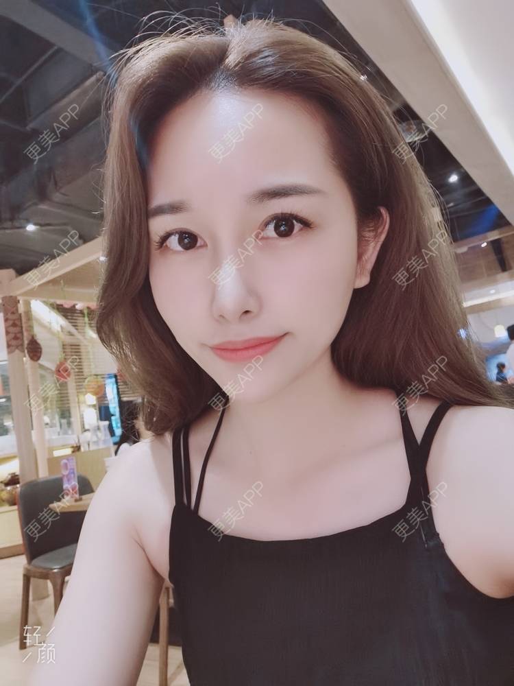 更美 - 甜心泡芙的双眼皮修复经验 | 双眼皮 | 全切双眼皮 | 开内眼角 | 重庆 | 双眼皮修复