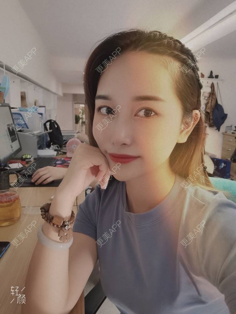 更美 - 甜心泡芙的双眼皮修复经验 | 双眼皮 | 全切双眼皮 | 开内眼角 | 重庆 | 双眼皮修复