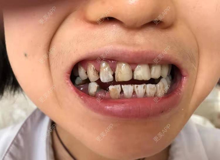 更美 - 更美用户HiWlCNhqku的二氧化锆烤瓷牙经验 | 二氧化锆烤瓷牙