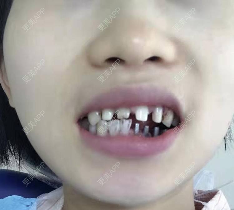 更美 - 更美用户HiWlCNhqku的二氧化锆烤瓷牙经验 | 二氧化锆烤瓷牙