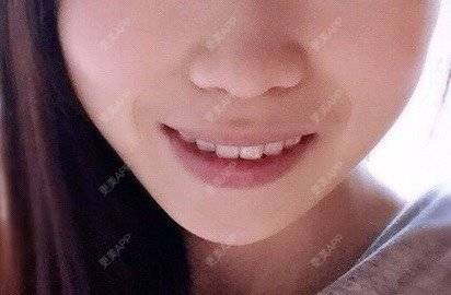 更美 - 更美用户HiWlCNhqku的二氧化锆烤瓷牙经验 | 二氧化锆烤瓷牙