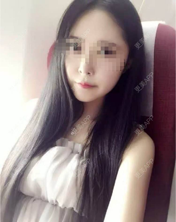 更美 - 浅暮、流殇べ贡的除皱经验 | 除皱 | 长沙