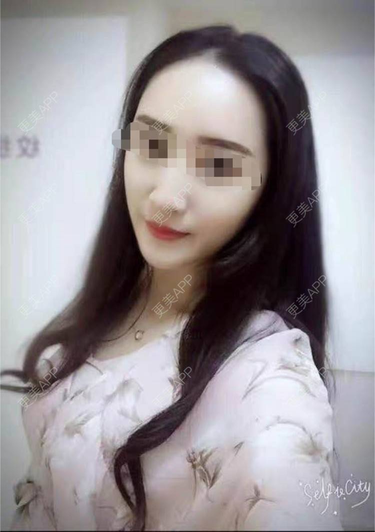 更美 - 浅暮、流殇べ贡的除皱经验 | 除皱 | 长沙