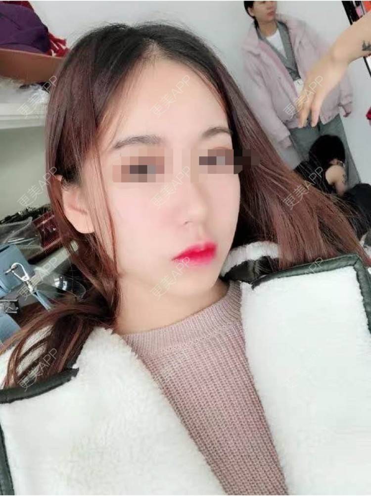 更美 - 情话滚烫哑的除皱经验 | 除皱 | 长沙