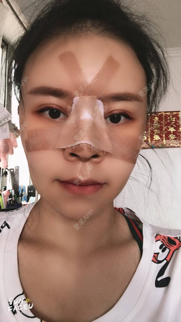 更美 - 更美用户iuB00h31N3的鼻部多项经验 | 肋软骨隆鼻 | 鼻部多项 | 广州