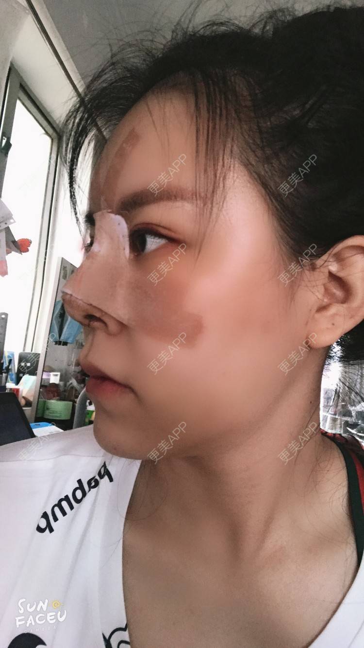 更美 - 更美用户iuB00h31N3的鼻部多项经验 | 肋软骨隆鼻 | 鼻部多项 | 广州