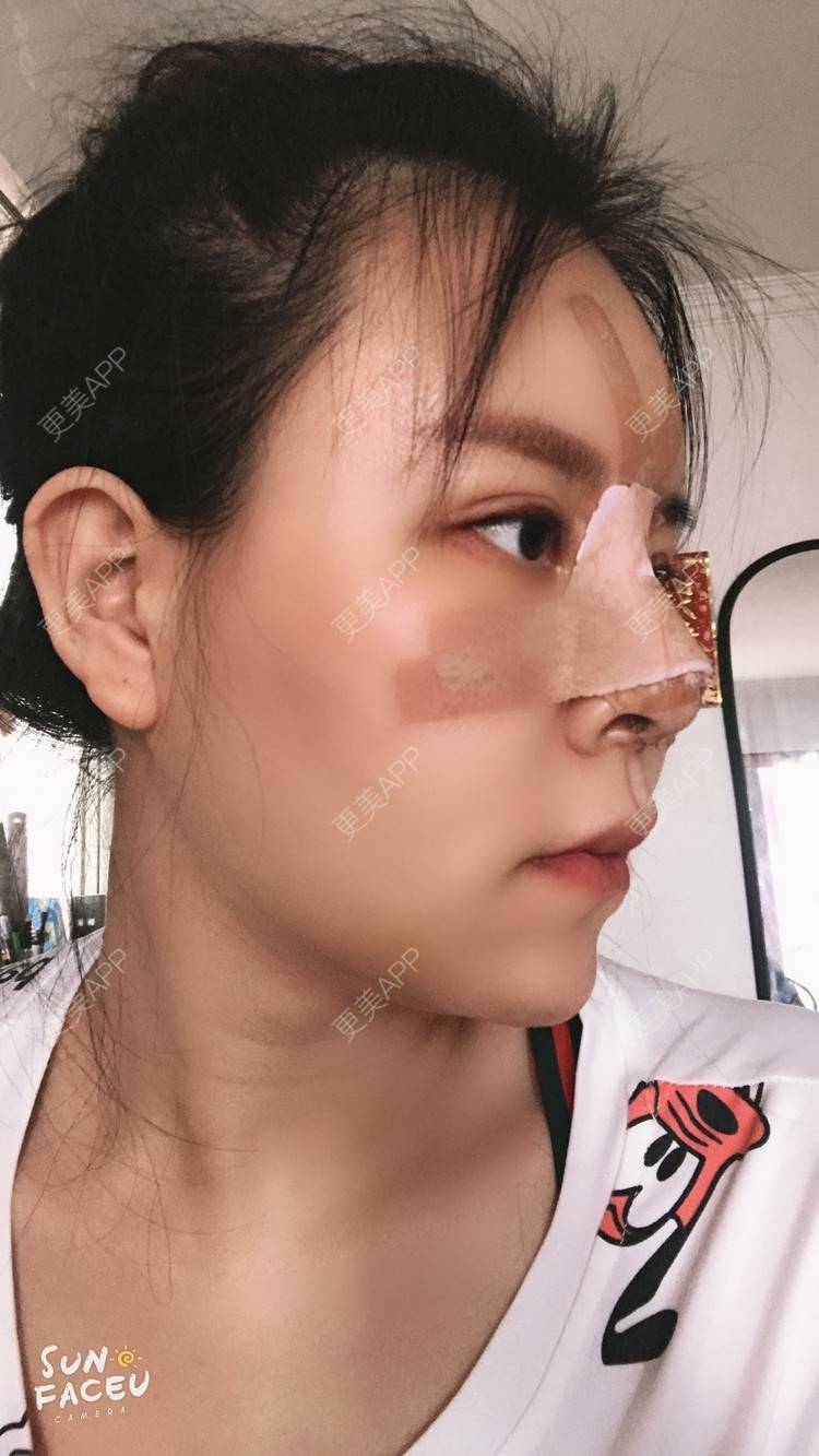 更美 - 更美用户iuB00h31N3的鼻部多项经验 | 肋软骨隆鼻 | 鼻部多项 | 广州