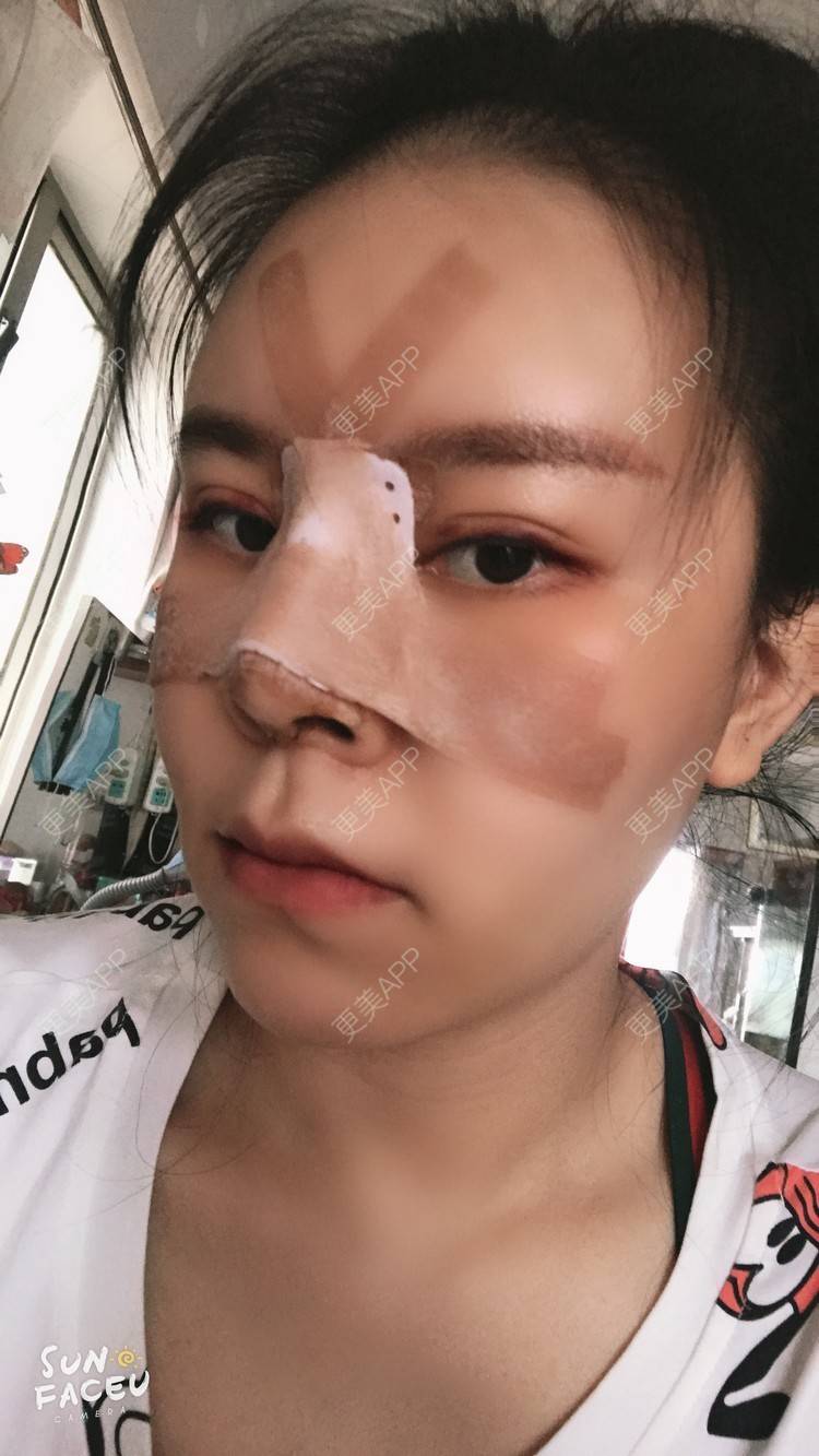更美 - 更美用户iuB00h31N3的鼻部多项经验 | 肋软骨隆鼻 | 鼻部多项 | 广州